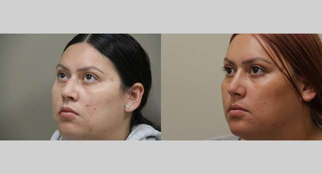 Nose Surgery: Image #991