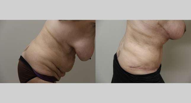 Tummy Tuck: Image #999